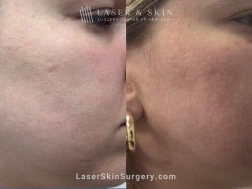 4 Microneedling Sessions, CO2 Laser Resurfacing, and Sculptra for Acne Scarring and Smoother Skin