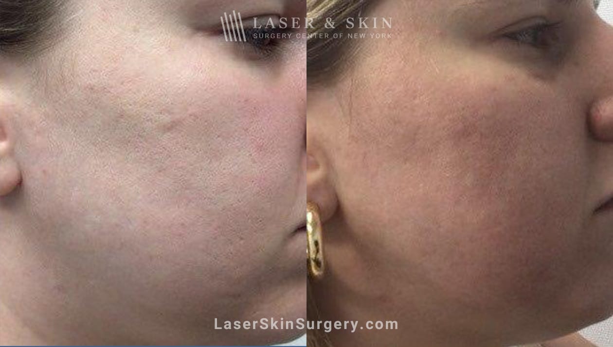 Skin needling before and after photos