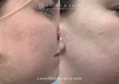 4 Microneedling Sessions, CO2 Laser Resurfacing, and Sculptra for Acne Scarring and Smoother Skin