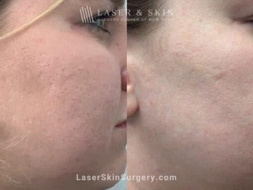 4 Microneedling Sessions, CO2 Laser Resurfacing, and Sculptra for Acne Scarring and Smoother Skin