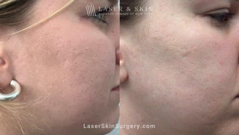 4 Microneedling Sessions, CO2 Laser Resurfacing, and Sculptra for Acne Scarring and Smoother Skin