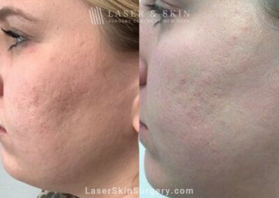 4 Microneedling Sessions, CO2 Laser Resurfacing, and Sculptra for Acne Scarring and Smoother Skin