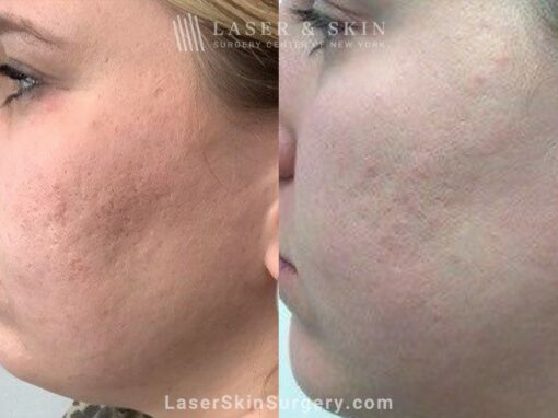 4 Microneedling Sessions, CO2 Laser Resurfacing, and Sculptra for Acne Scarring and Smoother Skin