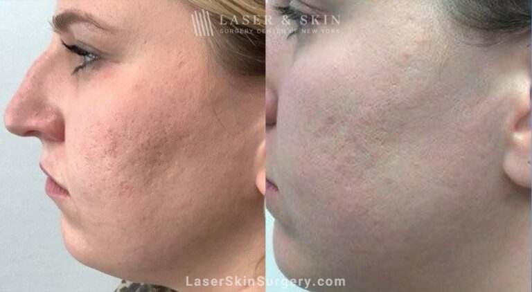 4 Microneedling Sessions, CO2 Laser Resurfacing, and Sculptra for Acne Scarring and Smoother Skin