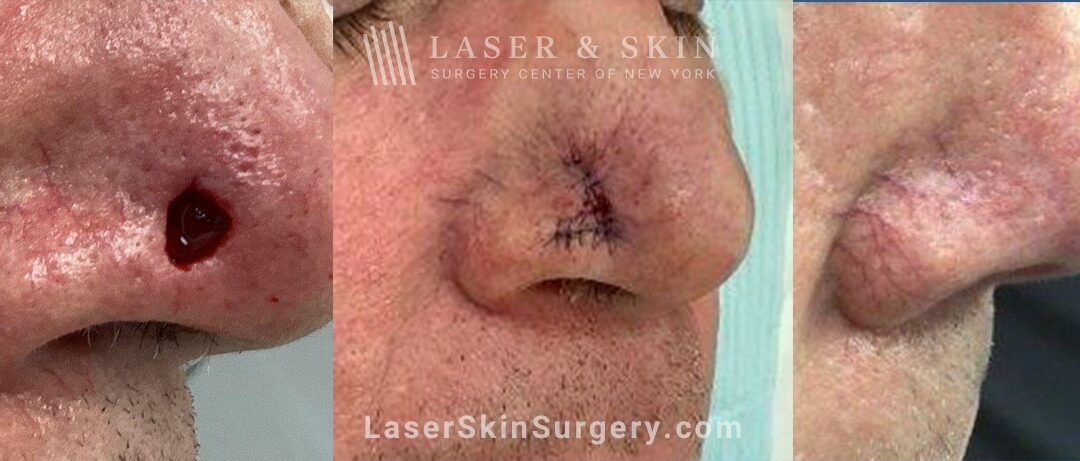 Mohs Surgery to Remove Skin Cancer on the Right Nostril with Minimal Scarring