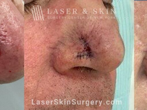 Mohs Surgery to Remove Skin Cancer on the Right Nostril with Minimal Scarring