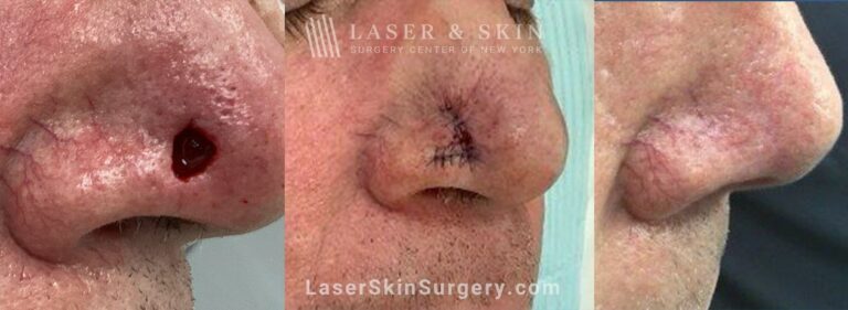 Mohs Surgery to Remove Skin Cancer on the Right Nostril with Minimal Scarring