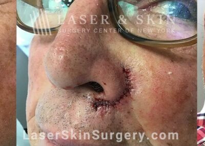 4.5 Years After Mohs Surgery on Upper Lip