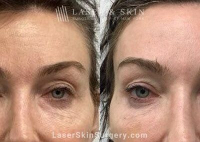 Two Weeks After Daxxify to Smooth Forehead Wrinkles in 50-Year-Old Patient