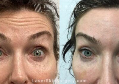Two Weeks After Daxxify to Smooth Forehead Wrinkles in 50-Year-Old Patient