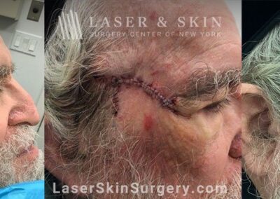 Mohs Surgery for Skin Cancer