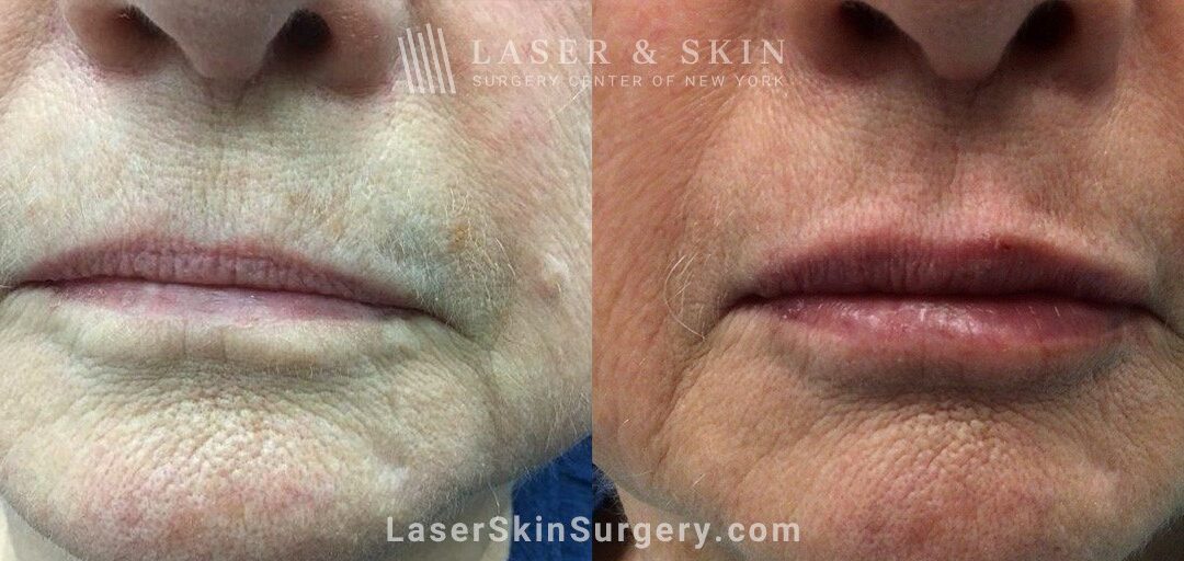 RHA 2 Fillers to Increase Lip Volume