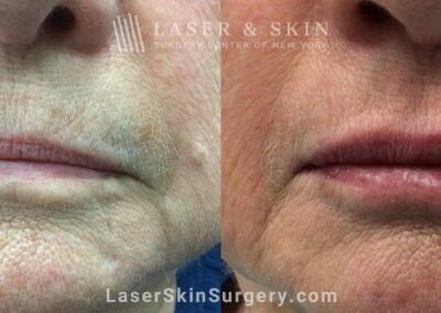 RHA 2 Fillers to Increase Lip Volume