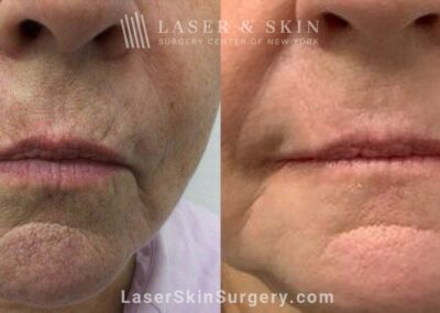 Ablative Erbium Laser to Tighten Skin in Perioral Area