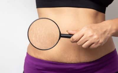 How to Minimize Stretch Marks After Pregnancy