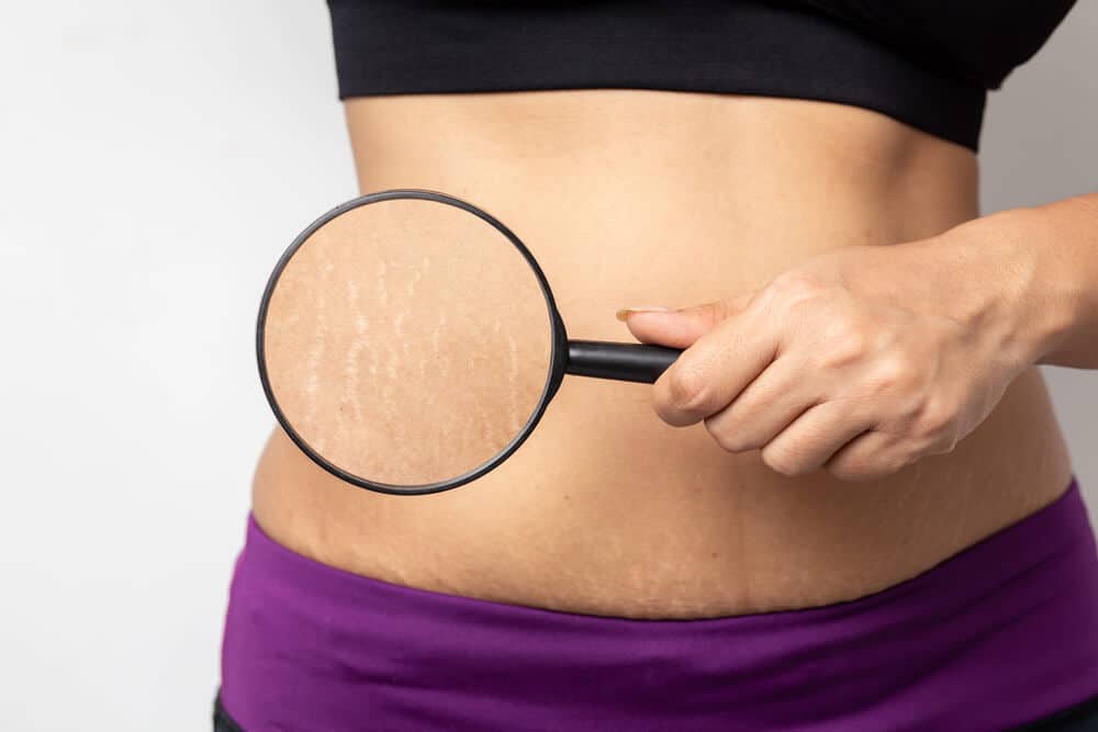 How to Minimize Stretch Marks After Pregnancy