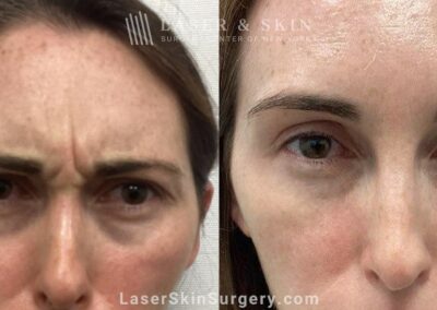 Daxxify to Treat Frown Lines