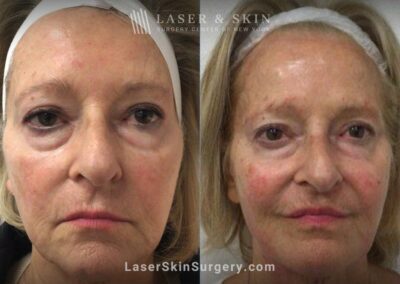 Juvederm Fillers to Rejuvenate the Face