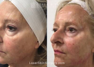 Juvederm Fillers to Rejuvenate the Face