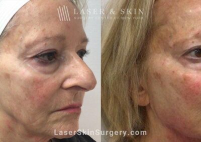 Juvederm Fillers to Rejuvenate the Face