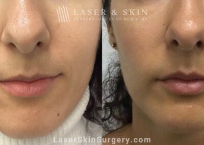 Sofwave to Tighten the Jawline and Lower Face