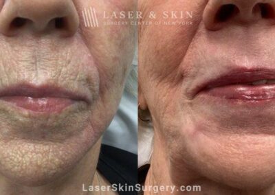Laser Resurfacing