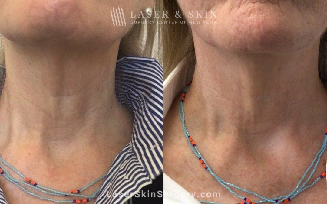 Ultherapy Sofwave