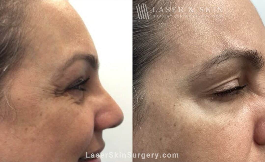 lssc-nyc-wrinkles-eyes-Shelton Jeuveau 100224 D
