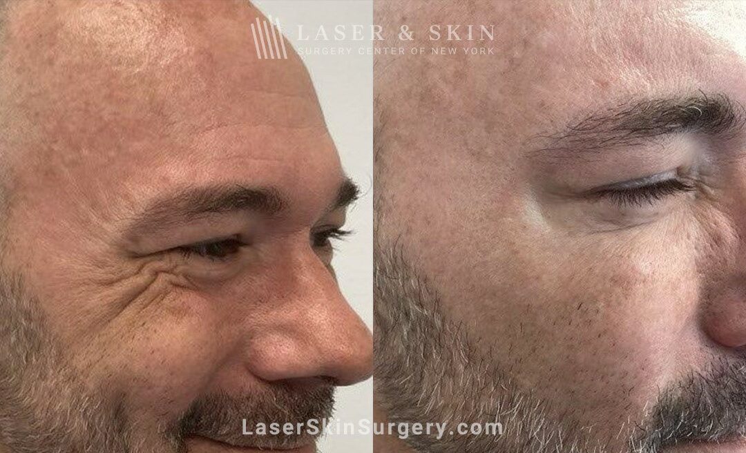 lssc-nyc-wrinkles-eyes-Shelton Jeuveau B 091324