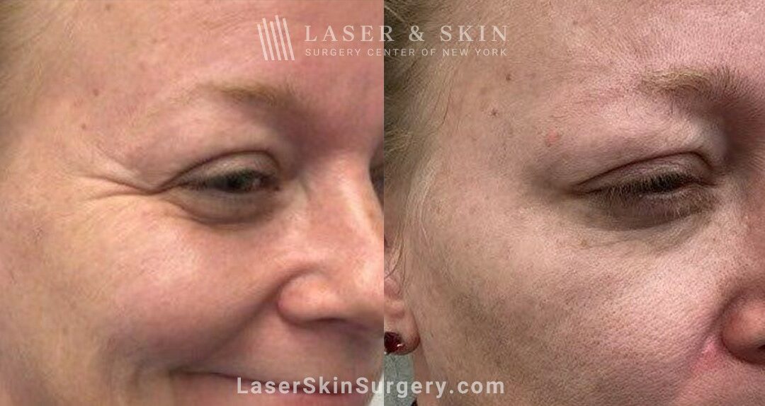 lssc-nyc-wrinkles-eyes-Shelton jeuveau 101524 C