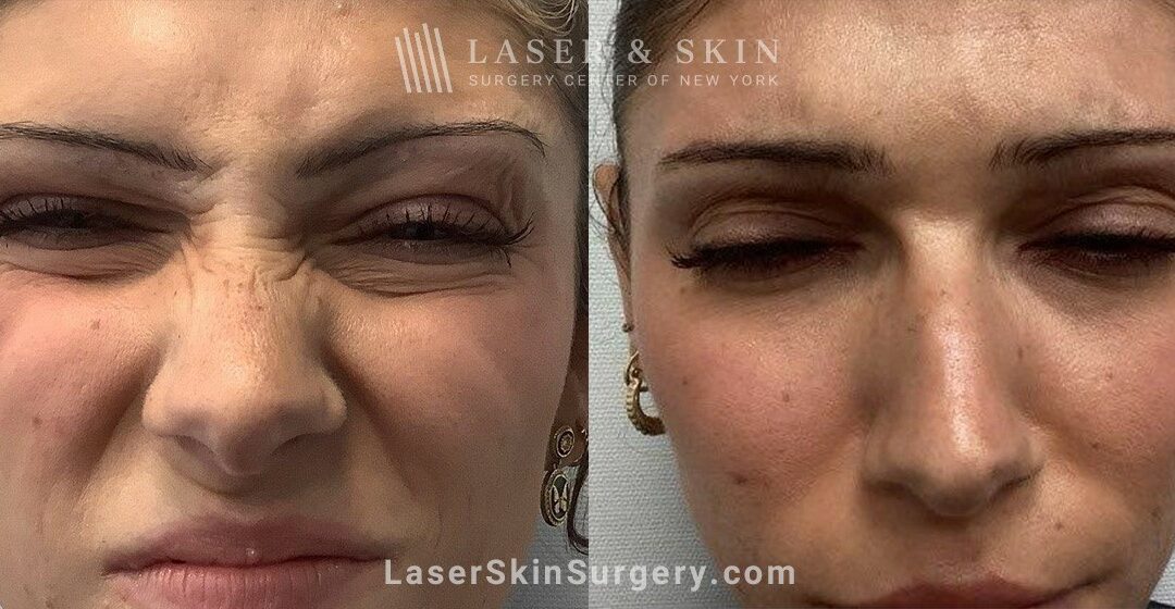 lssc-nyc-wrinkles-face-Shelton Jeuveau B 091624