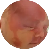 Port-Wine Stain Treatment