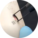 Tattoo Removal