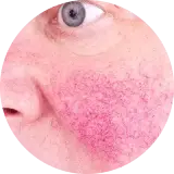 Rosacea