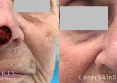 Hoffman Mohs Bilateral Rotation Flap