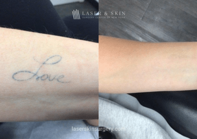 PicoPlus Laser Tattoo Removal