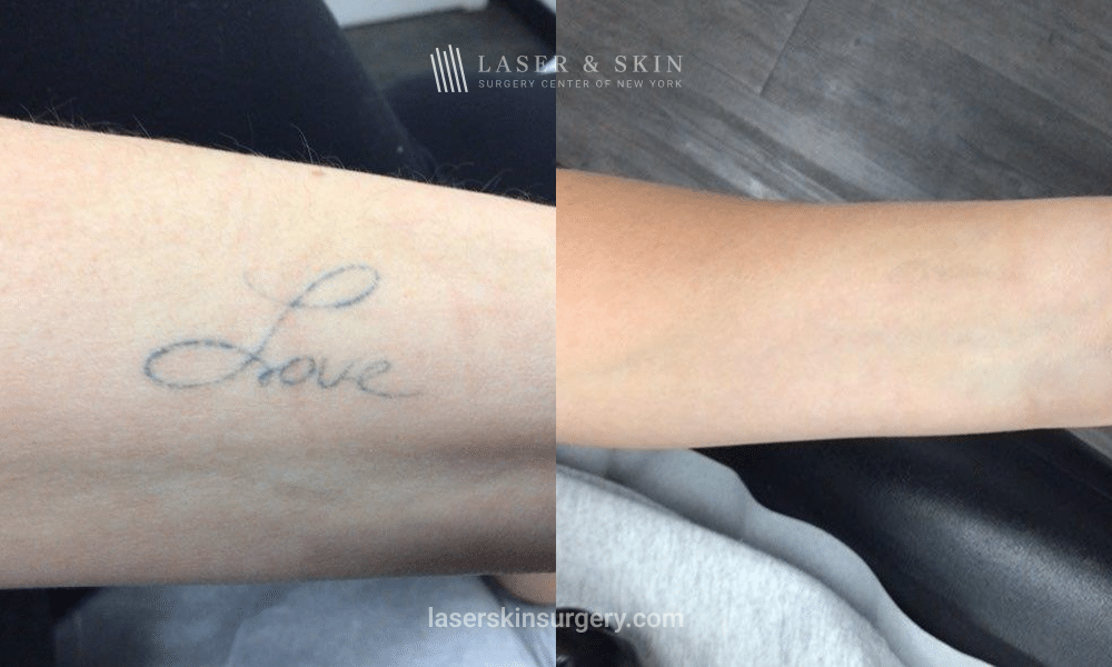 Before and After - PicoPlus Laser Tattoo Removal