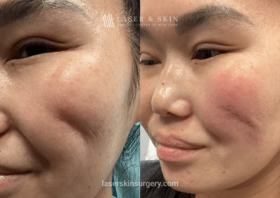 Subcision and Evolysse Smooth Filler