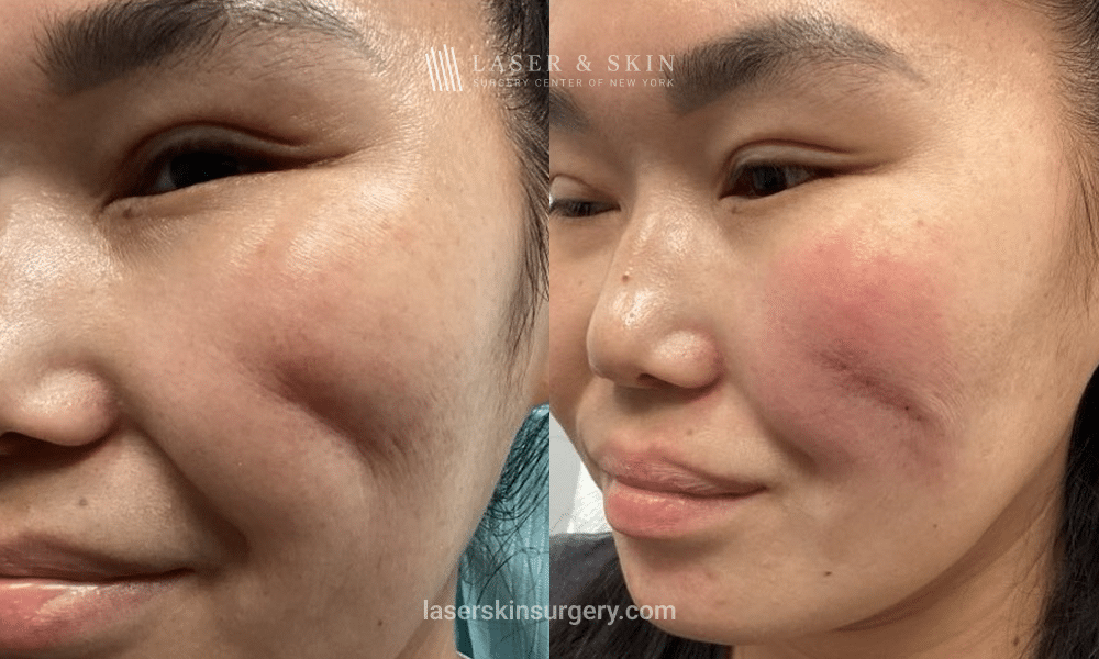 Before and After - Subcision and Evolysse Smooth Filler