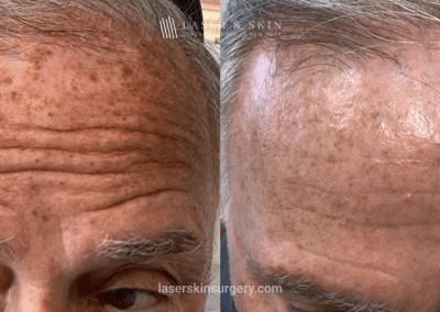 Fraxal and Q-Switched Ruby Laser for Sun Damage – Front 2