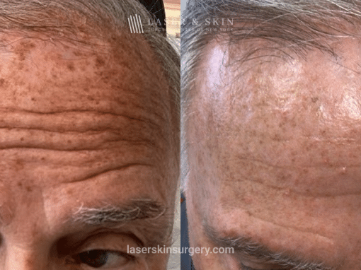 Fraxal and Q-Switched Ruby Laser for Sun Damage – Front 2