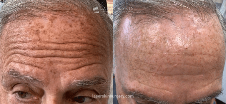 Fraxal and Q-Switched Ruby Laser for Sun Damage – Front 2