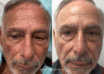 Fraxal and Q-Switched Ruby Laser for Sun Damage – Front