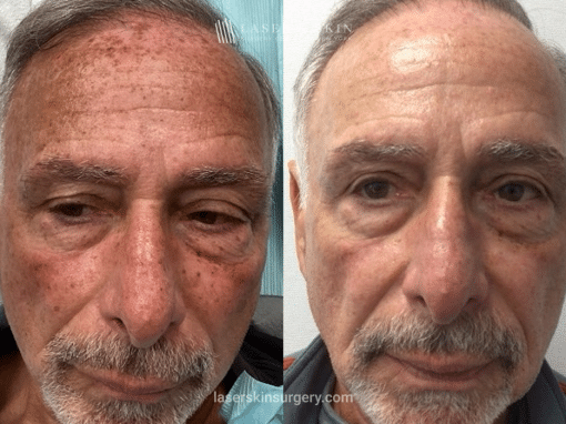 Fraxal and Q-Switched Ruby Laser for Sun Damage – Front