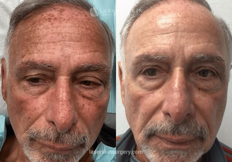 Fraxal and Q-Switched Ruby Laser for Sun Damage – Front