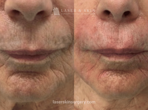 Immediate Results with Evolysse Smooth Filler