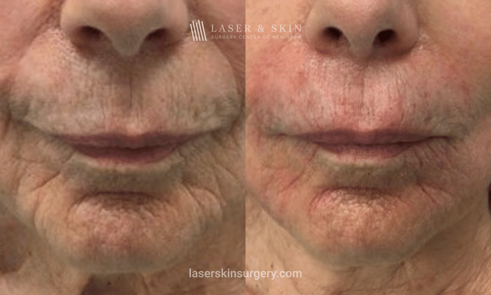 Immediate Results with Evolysse Smooth Filler (1)