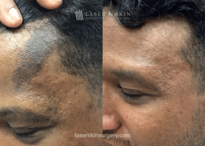 PicoPlus Laser Birthmark Removal – Immediate Results with Evolysse Smooth Filler