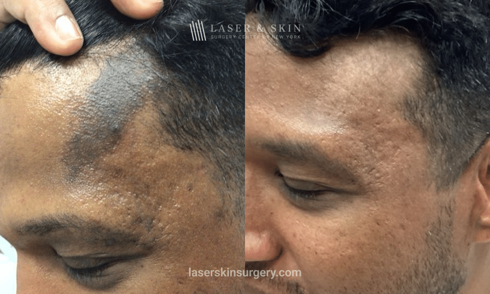 Immediate Results with Evolysse Smooth Filler