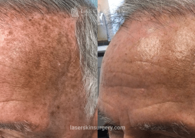 Fraxal and Q-Switched Ruby Laser for Sun Damage – LO Forehead